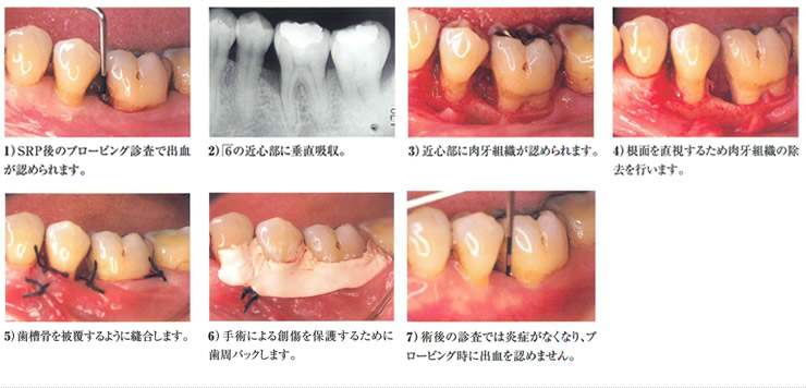 最終的に悪い部分を絞り込んで歯周外科処置を行いますイメージ