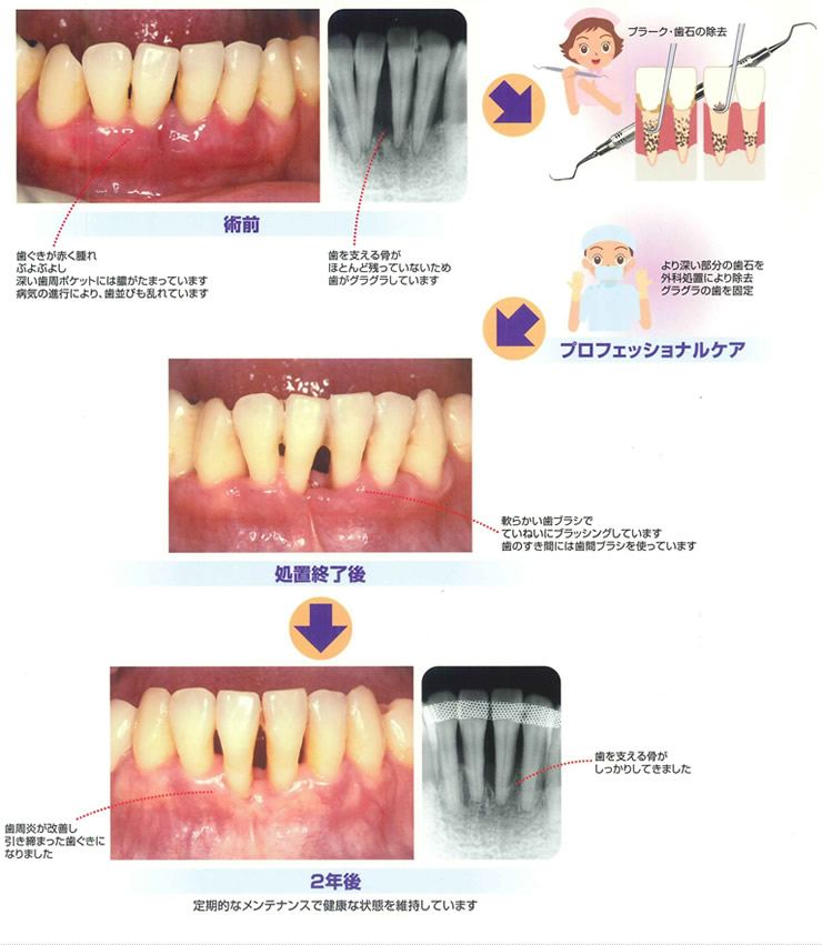 かなり骨吸収が進行した状態では隣の歯と連結固定して延命しますイメージ