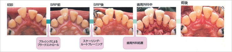 重度歯周炎の治療ステップイメージ