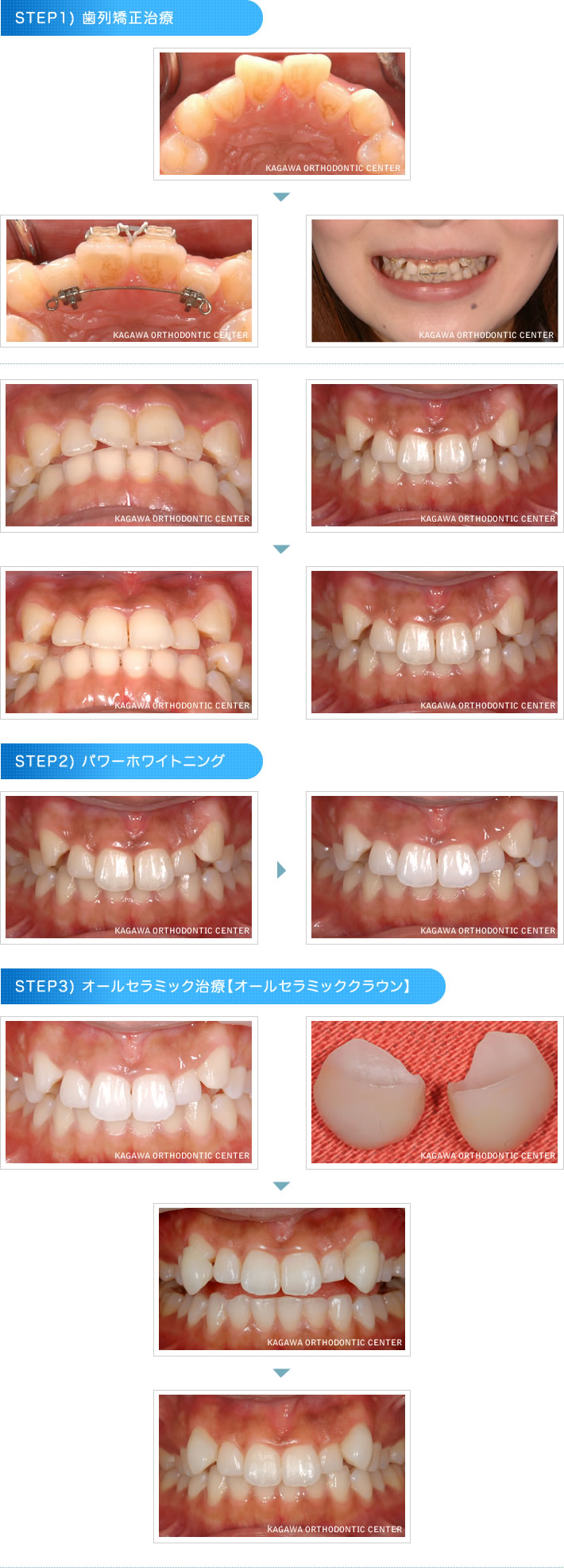 矯正治療の流れイメージ