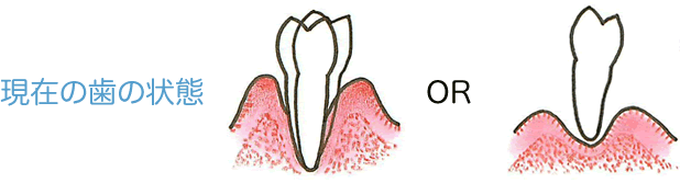 現在の歯の状態
