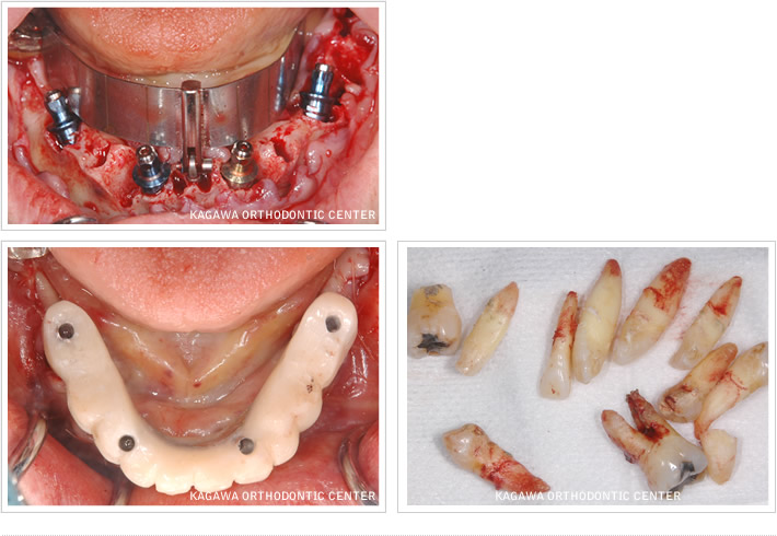 抜歯即時負荷インプラント手術（下顎）症例写真