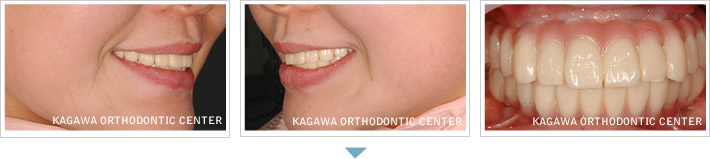 抜歯即時負荷インプラント手術（下顎）症例２
