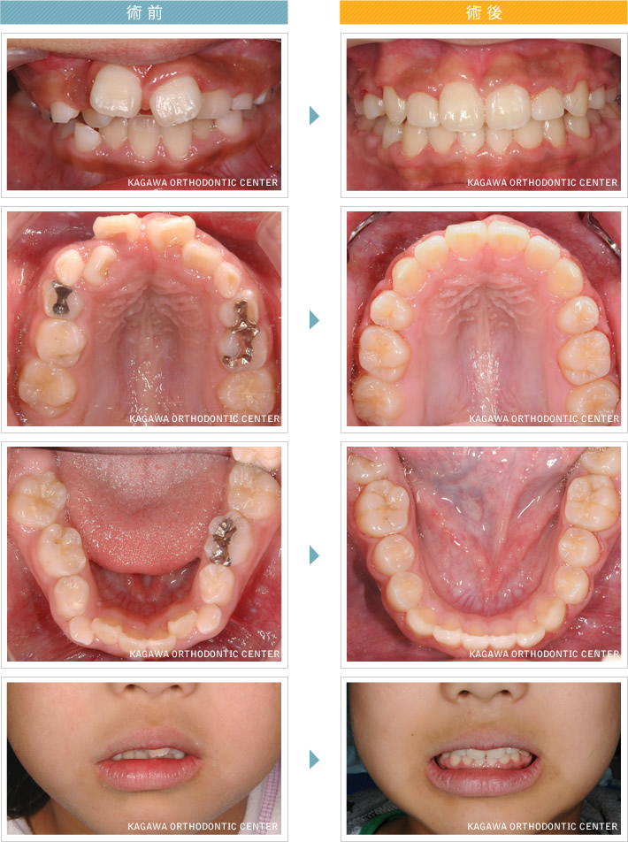子供 歯 列 矯正 費用
