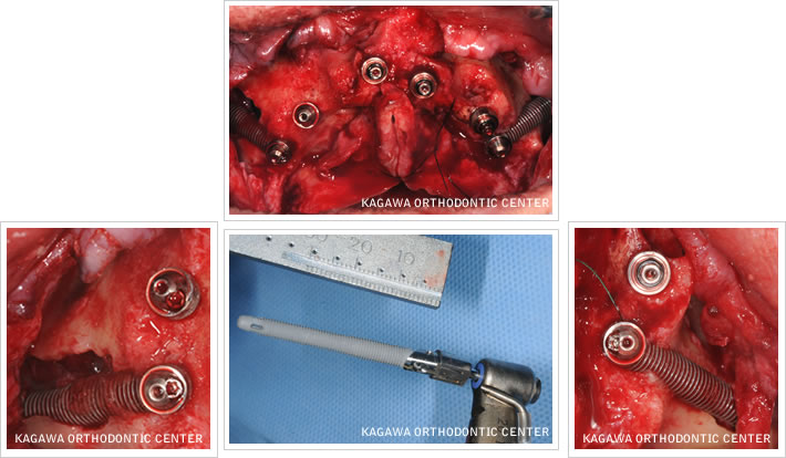 2、特殊インプラント手術（ザイゴマインプラント）