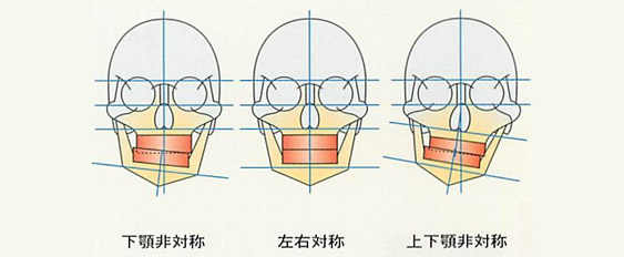 下顎非対称　左右対称　上下顎非対称