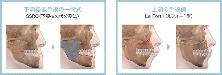 下顎後退手術の一術式 上顎の手術例