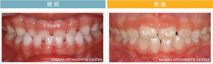 【5歳女の子】反対咬合の改善