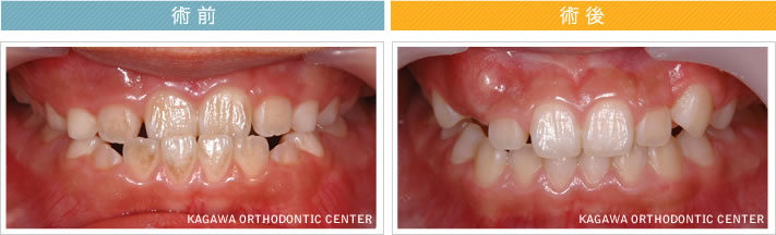 【7歳男の子】反対咬合の改善 