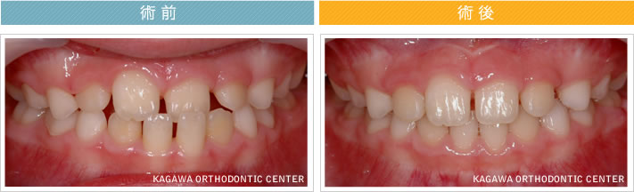 【８歳男の子】反対咬合の改善
