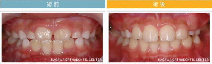 【7歳男の子】反対咬合の改善