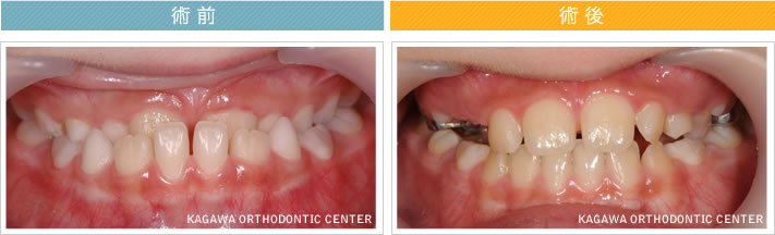 【7歳女の子】上唇小帯短縮症を伴う反対咬合の改善