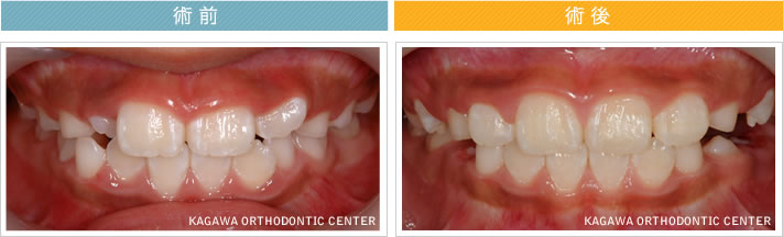 【８歳男の子】反対咬合 及び 叢生の改善