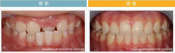 【7歳男の子】反対咬合の改善