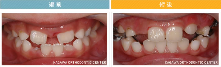 【６歳男の子】正中埋伏過剰歯による正中離開を伴う反対咬合の改善