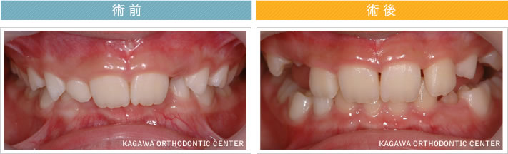 【８歳女の子】過蓋咬合の改善