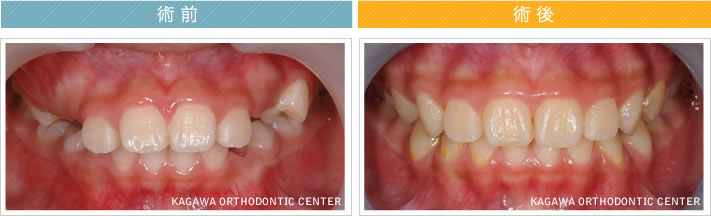 【８歳女の子】上顎前突の改善