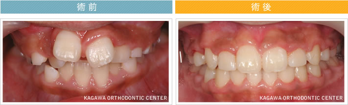 【8歳女の子】上顎前突 及び 叢生の改善