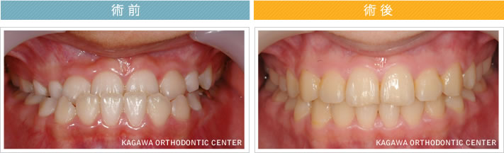 【1０歳女の子】反対咬合の改善
