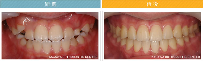 【11歳男の子】反対咬合 及び 叢生の改善