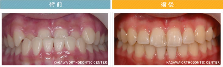 【13歳女の子】反対咬合の改善