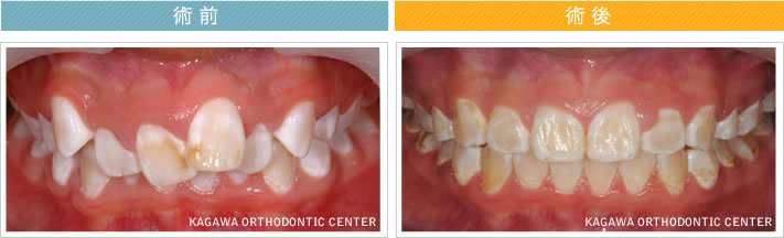 【11歳女の子】上顎前突 及び 叢生の改善
