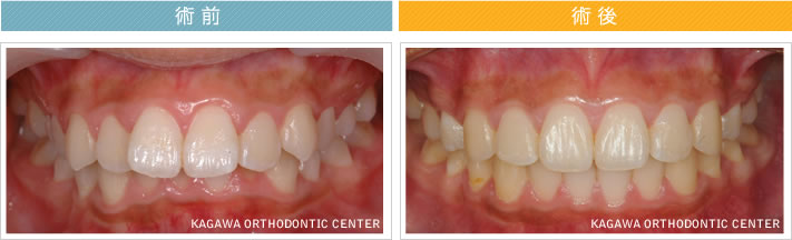 【1７歳女の子】上顎前突 及び 叢生の改善　