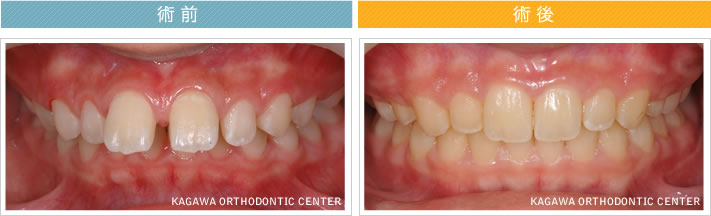 【12歳女の子】上顎前突 及び 空隙歯列の改善
