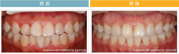【２０歳女性】上下顎前突 及び 叢生の改善