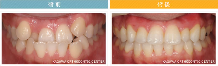 【２３歳女性】反対咬合 及び 叢生の改善