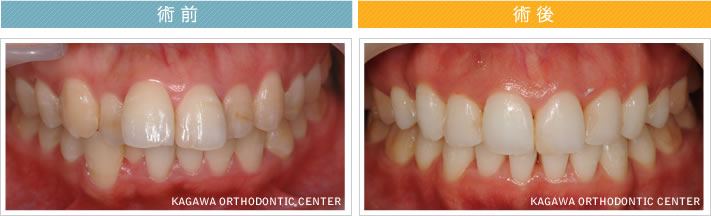 【２５歳女性】上下顎前突 及び 叢生の改善 