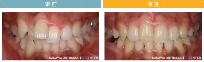 【２５歳女性】上下顎前突 及び 叢生の改善 