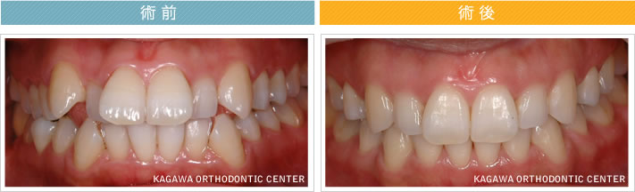【２７歳女性】上下顎前突 及び 叢生の改善
