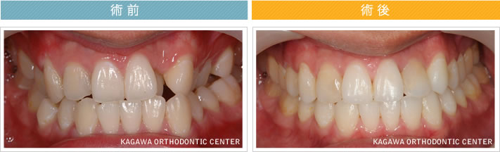 【２８歳男性】反対咬合 及び 叢生の改善