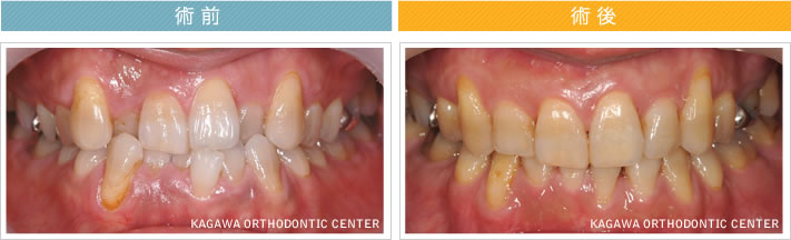 【31歳男性】反対咬合 及び 叢生の改善