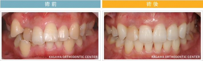 【33歳女性】上顎前突 及び 叢生の改善