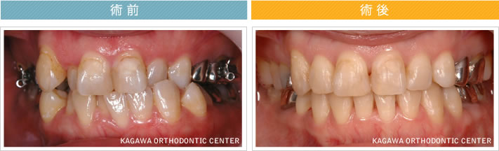 【36歳女性】反対咬合 及び 叢生の改善