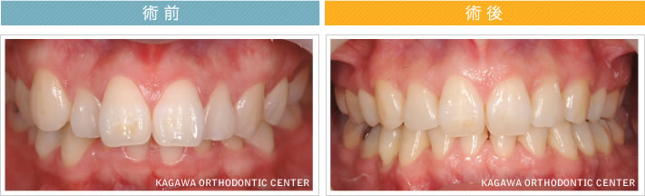 【23歳女性】上下顎前突 及び 叢生の改善