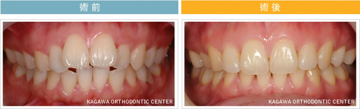 【25歳女性】開口を伴う上下顎前突 及び 叢生の改善