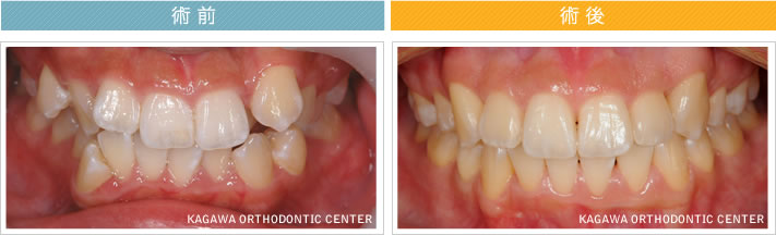 【29歳女性】反対咬合 及び 叢生の改善