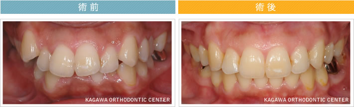 【29歳女性】上下顎前突 及び 叢生の改善