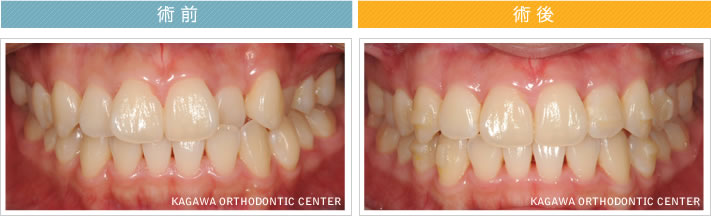 【22歳女性】反対咬合 及び 叢生の改善