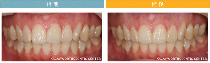【27歳女性】上の前歯の限局矯正（動的治療期間6ヶ月）