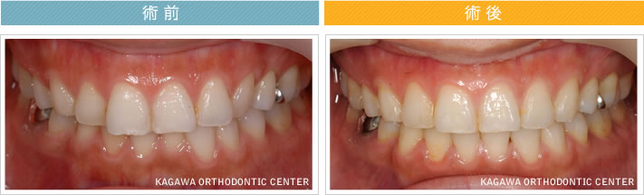 【28歳女性】上下の前歯の限局矯正（動的治療期間5ヶ月）