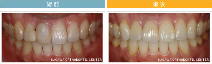 【25歳女性】歯列矯正→パワーホワイトニング・オールセラミッククラウン