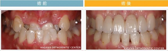 【42歳女性】歯列矯正+オールセラミックブリッジ