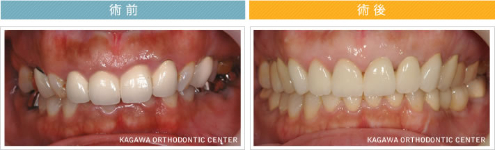 【4４歳女性】　歯列矯正+インプラント及び歯周外科+オールセラミッククラウン