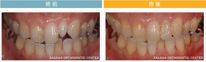 【31歳女性】　1本のオールセラミック治療で歯並びも改善