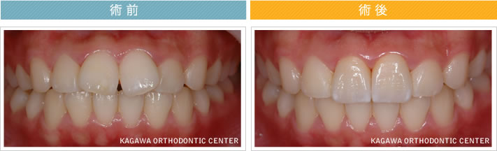 【21歳女性】　2本のオールセラミック治療で歯並びも改善