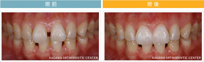 【26歳女性】　2本のオールセラミック治療で歯並びも改善